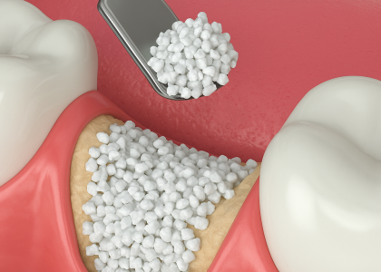 Bone_Graft